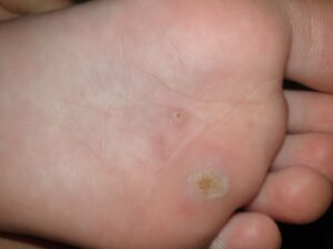 RIMOZIONE DI VERRUCHE CON LASER A DIODI
