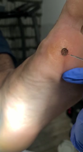 RIMOZIONE DI VERRUCHE CON LASER A DIODI
